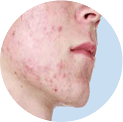 Sẹo trên mặt do mụn gây ra